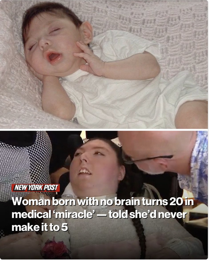 无脑儿奇迹存活20年,打破医生5岁预言